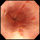 中程度の粘膜障害がある食道